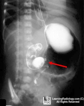 malrotation with a midgut volvulus