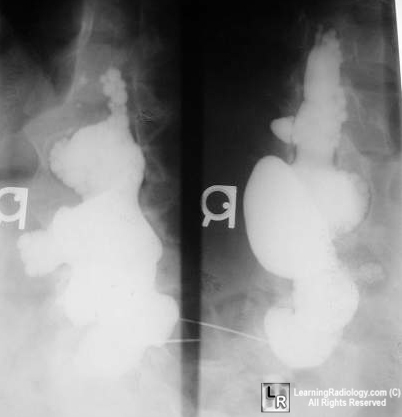 dural ectasis, neurofibromatosis