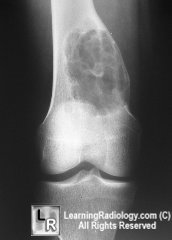 Non-Ossifying Fibroma