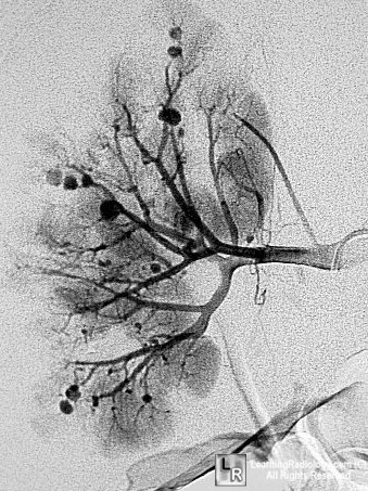 Polyarteritis Nodosa