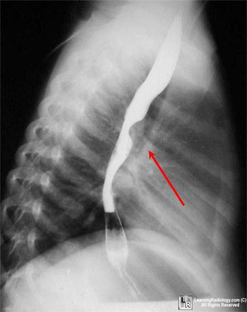 pulmonary sling