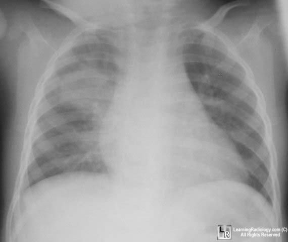 round pneumonia