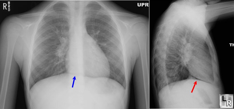 pneumomediastinum