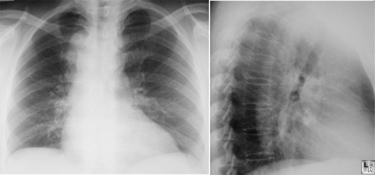 Aberrant Left Subclavian
