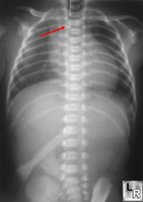 Esophageal atresia