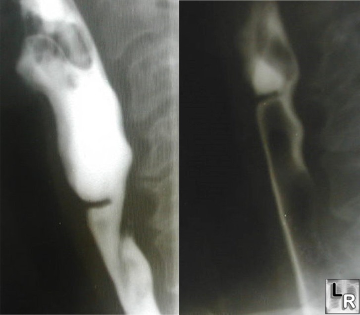 Esophageal Web