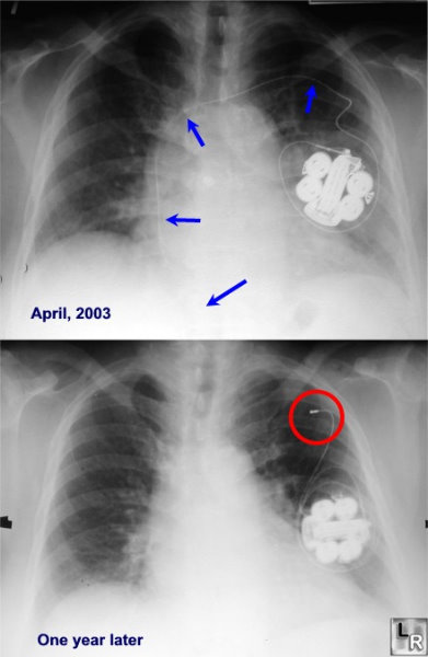 twiddler's syndrome