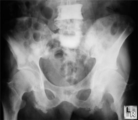 Multiple osteoblastic metastases