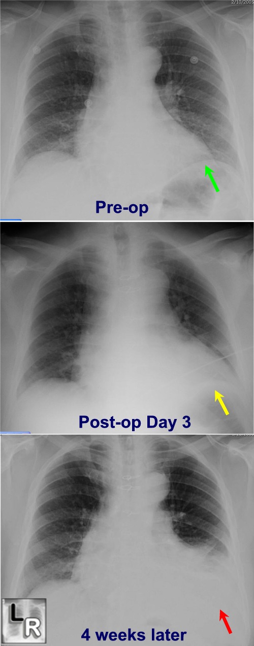 dressler syndrome