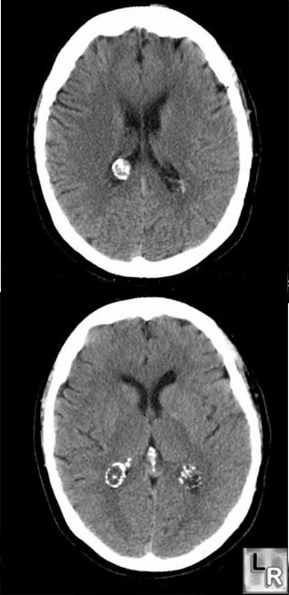 choroid plexus cysts