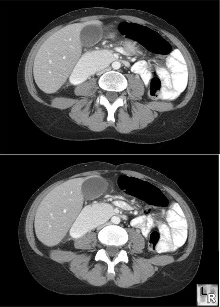 2nd portion of duodenum