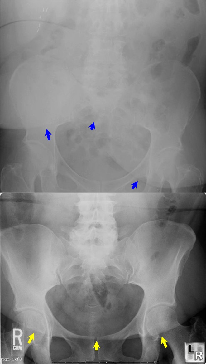 Puckered Panniculus Sign