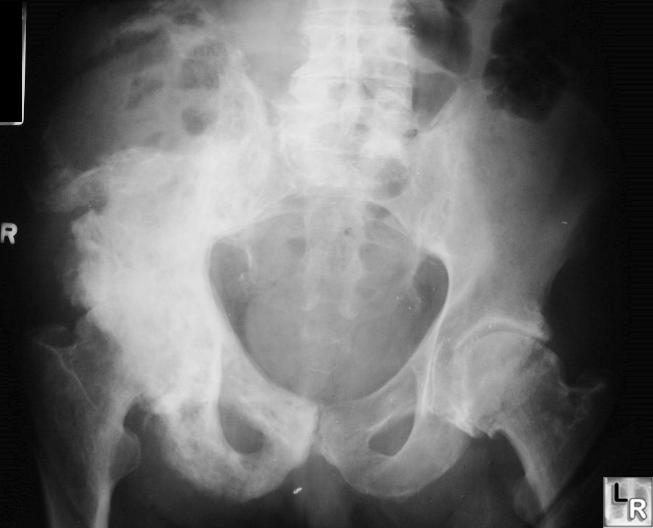 Osteosarcoma in Paget Disease