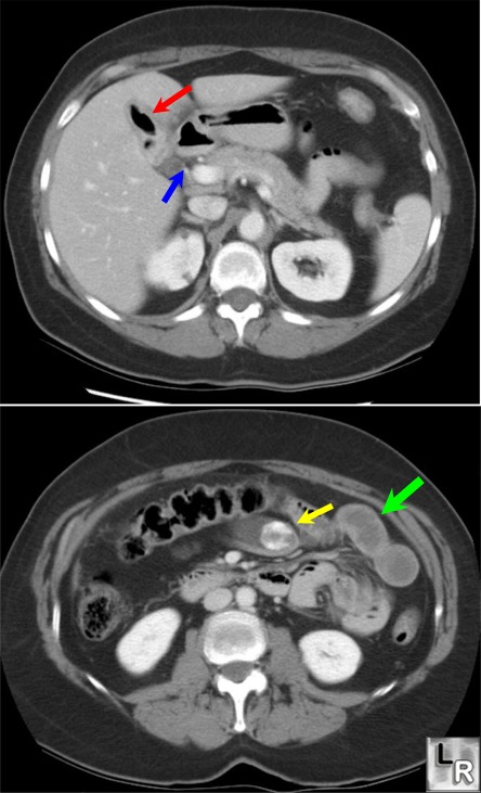 Gallstone Ileus