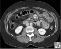 Gallstone Ileus