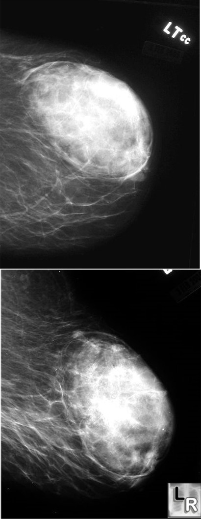 breast hamartoma