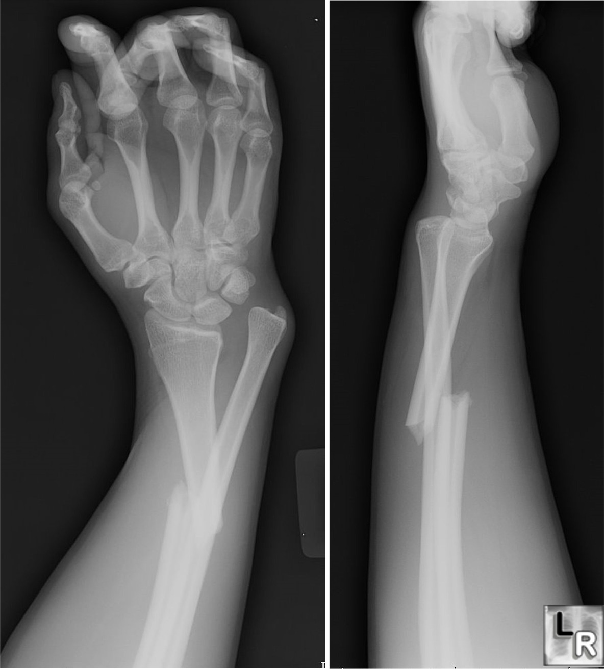 Galeazzi fracture