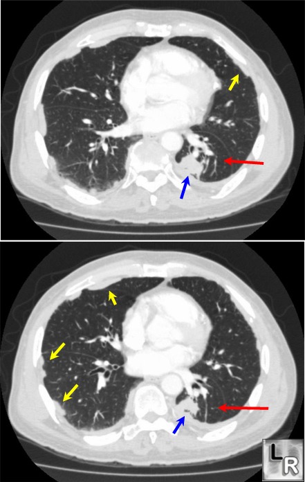 Rounded Atelectasis