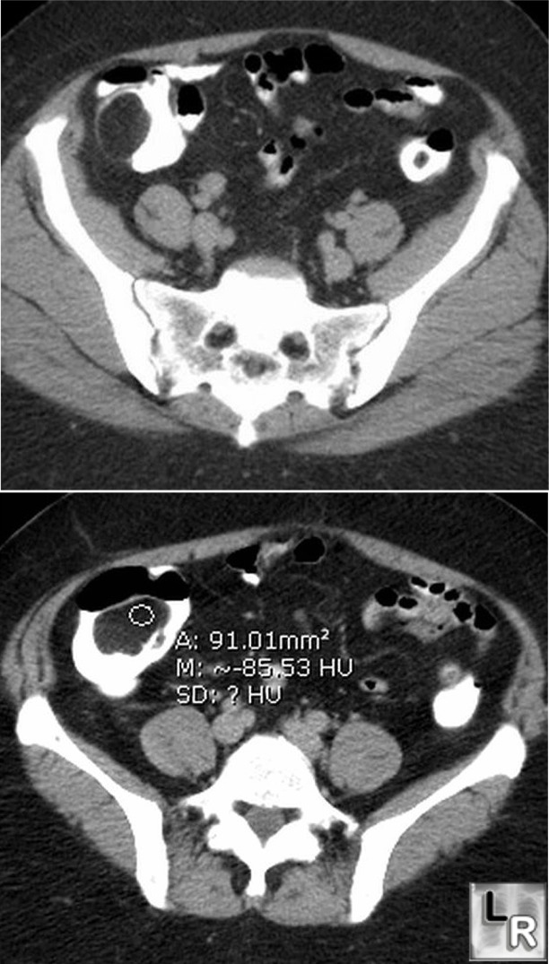 cecal lipoma