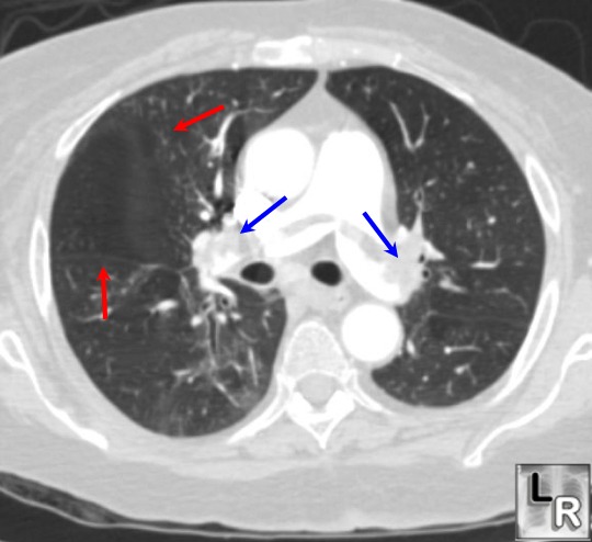 Pulmonary embolism