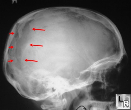 Leptomeningeal Cyst