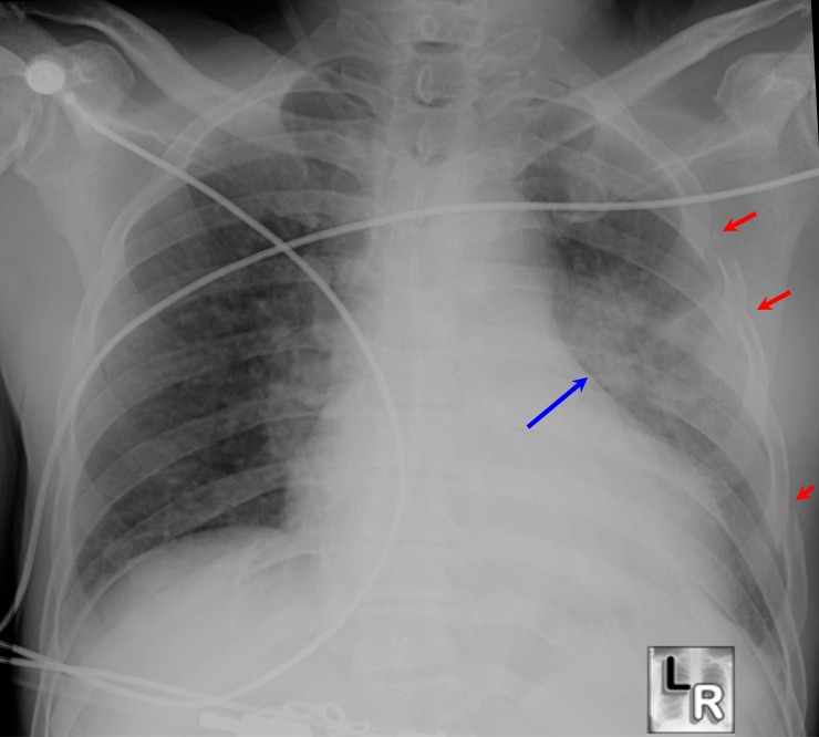 Pulmonary Contusion