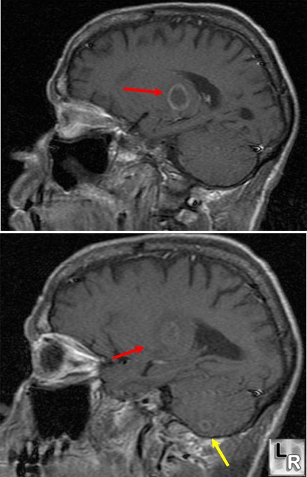 toxoplasmosis