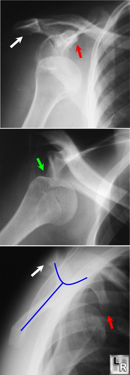 Anterior Dislocation of the Humeral Head