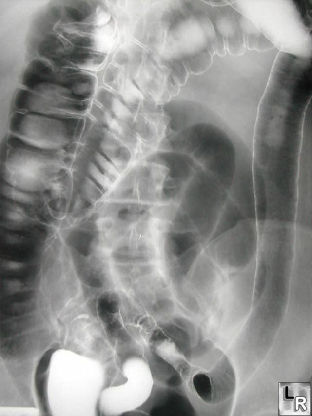 The distribution and appearance are suggestive of ulcerative colitis.