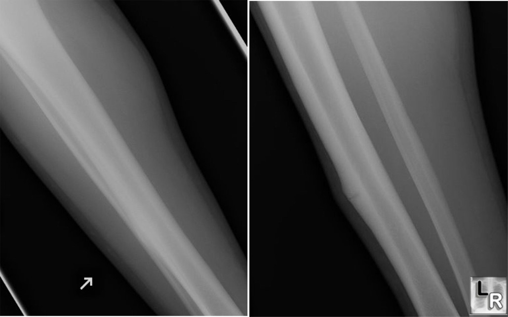 the tibia and fibula in a