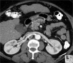 Fibromuscular Hyperplasia