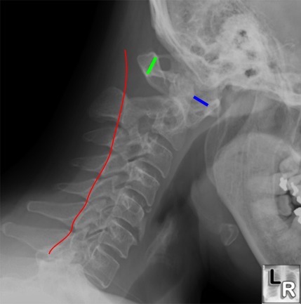 ra of c-spine