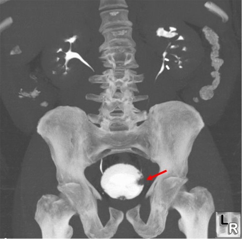 bladder cancer