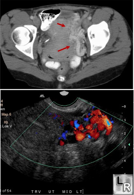 pelvic congestion syndrome