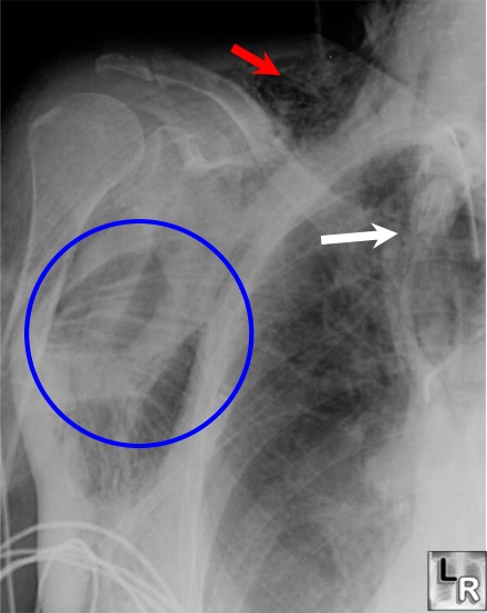 subcuraneous emphysema, chest