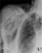 Subcutaneous Emphysema