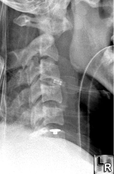 Atlantoaxial dislocation