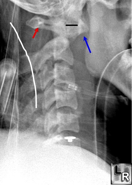 spinal dislocation