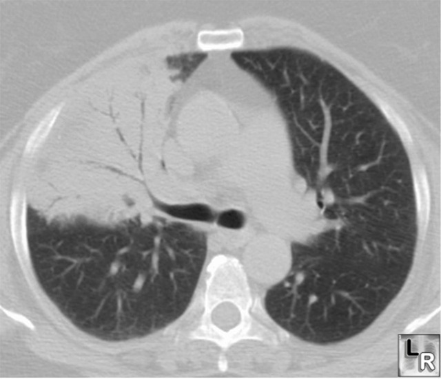 Pneumococcal pneumonia