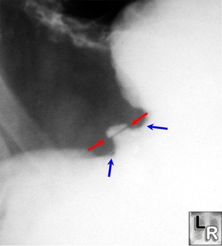 Intact mucosa to edge of ulcer