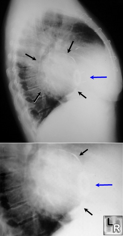 Calcification of left atrial wall