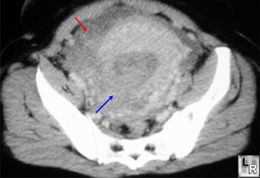 uterine rupture