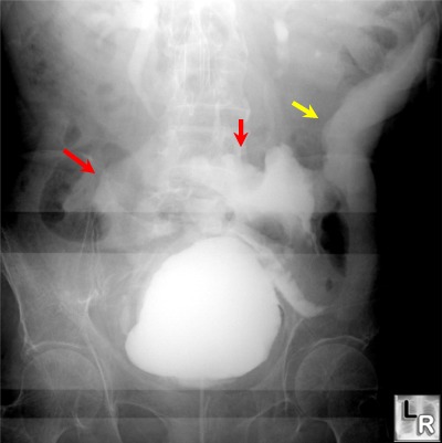 bladder rupture