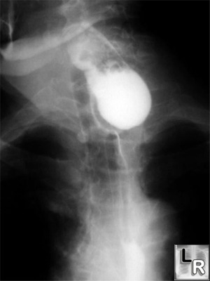 Epiphrenic Diverticulum