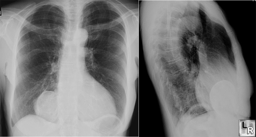 Pericardial Cyst