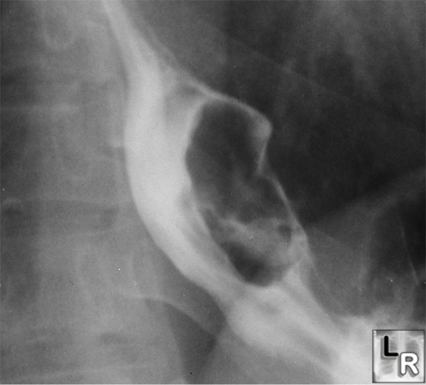 leiomyoma esophagus