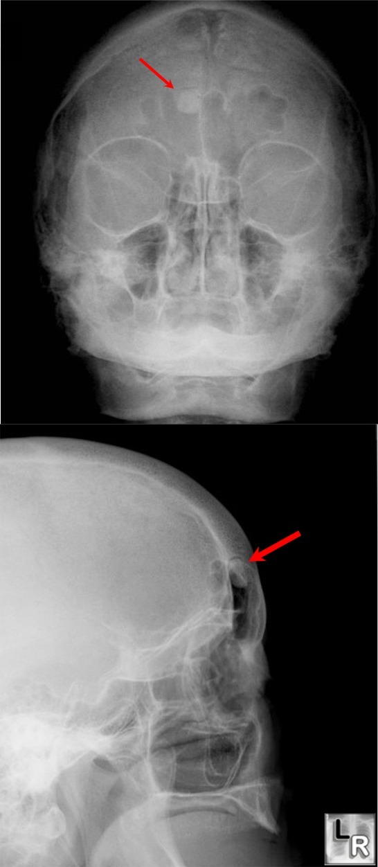 Osteoma,frontal,sinus,mandible,polyposis,gardner's,gardener's,syndrome
