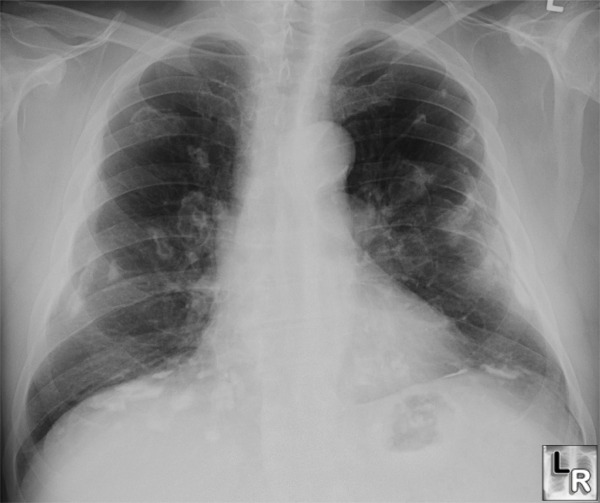 Knowing Pleural Plaques