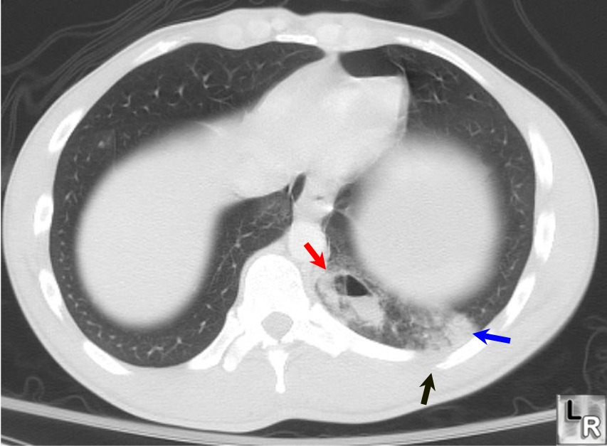 Pulmonary laceration