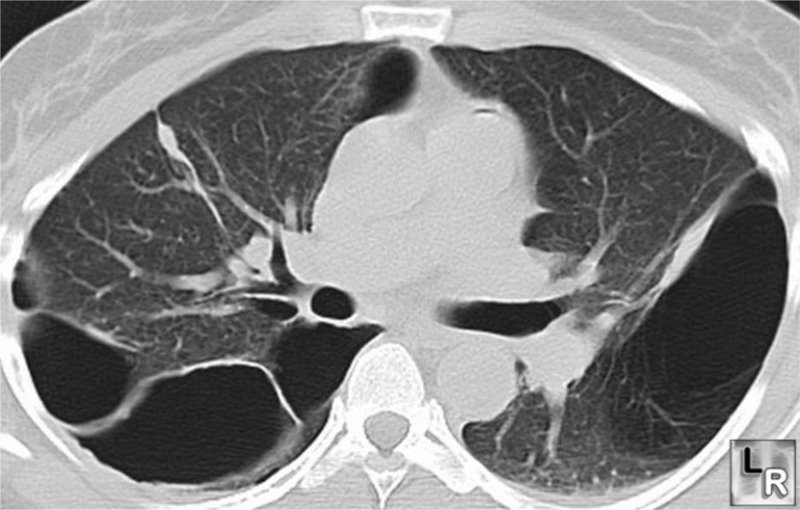 Pleural Diseases Light Free Download